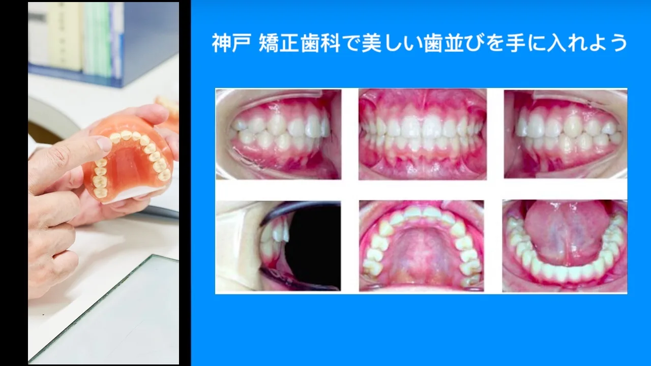 神戸-矯正歯科で美しい歯並びを手に入れよう.webp